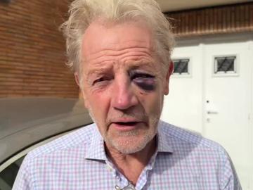 Guy (70) houdt gebarsten jukbeen en gezwollen oog over aan berisping van stepper